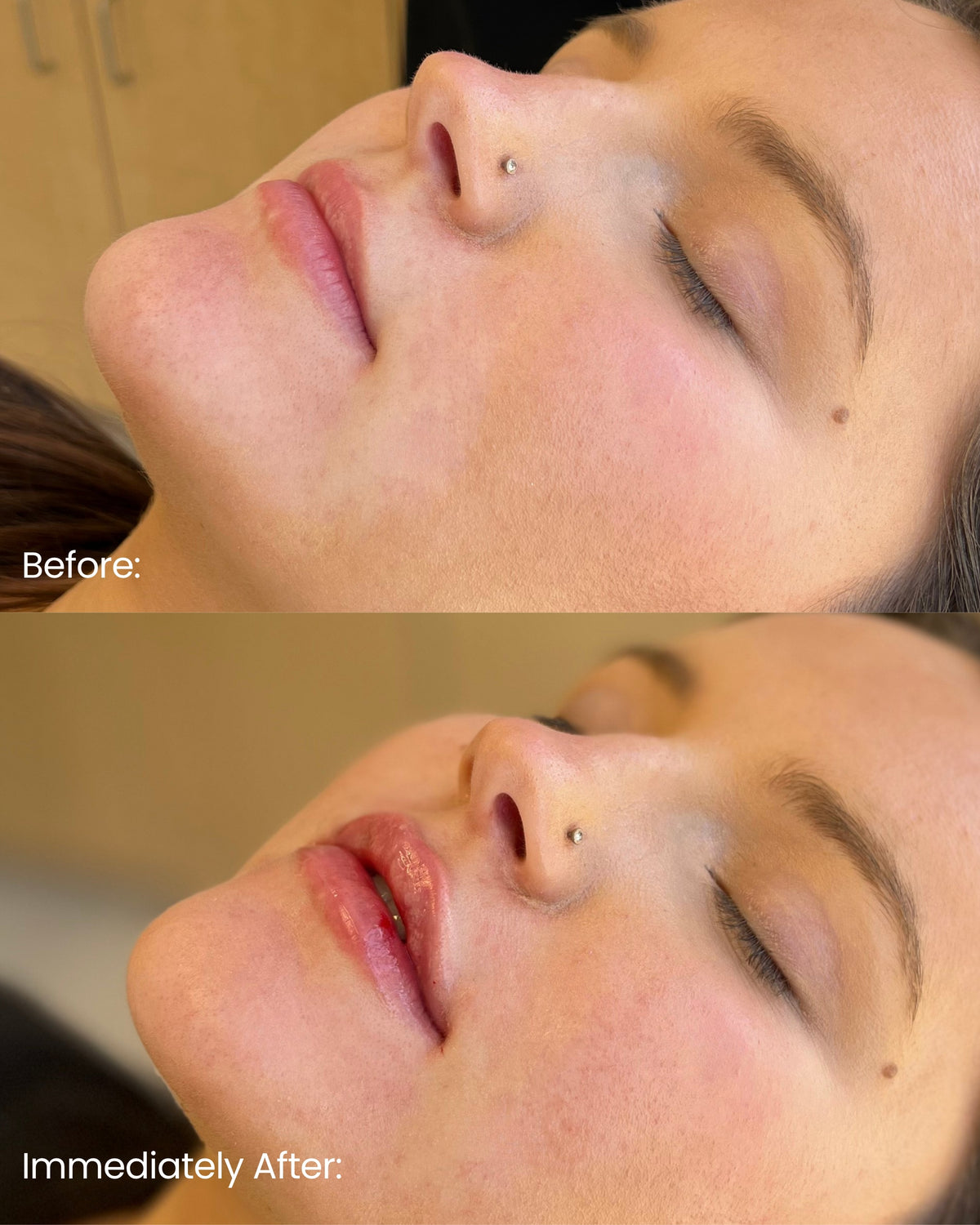 Lip Filler — Immediate Results