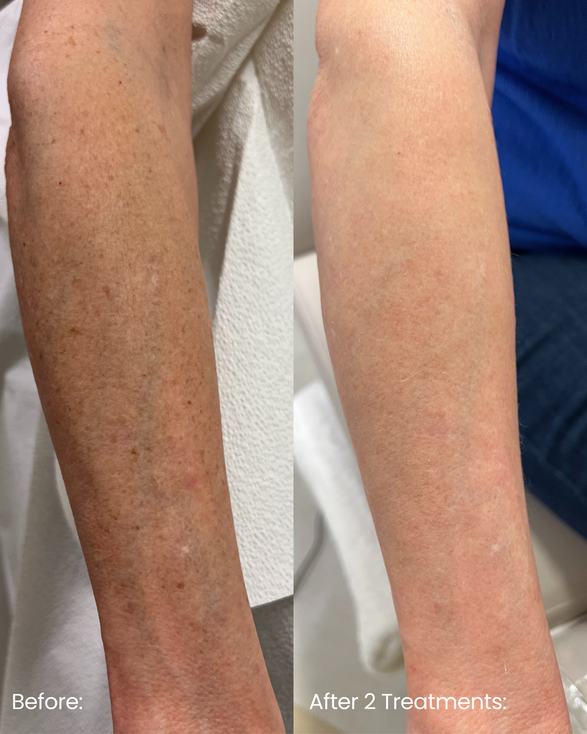 Cutera Limelight IPL Photofacial
