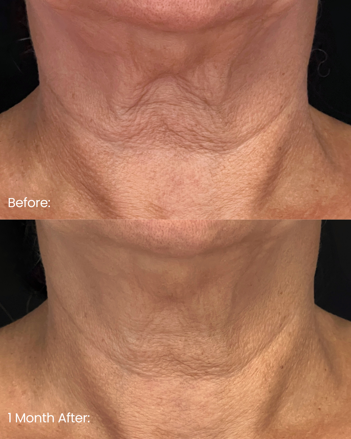 BioWeave™ Gold Neck Protocol — 1 Month