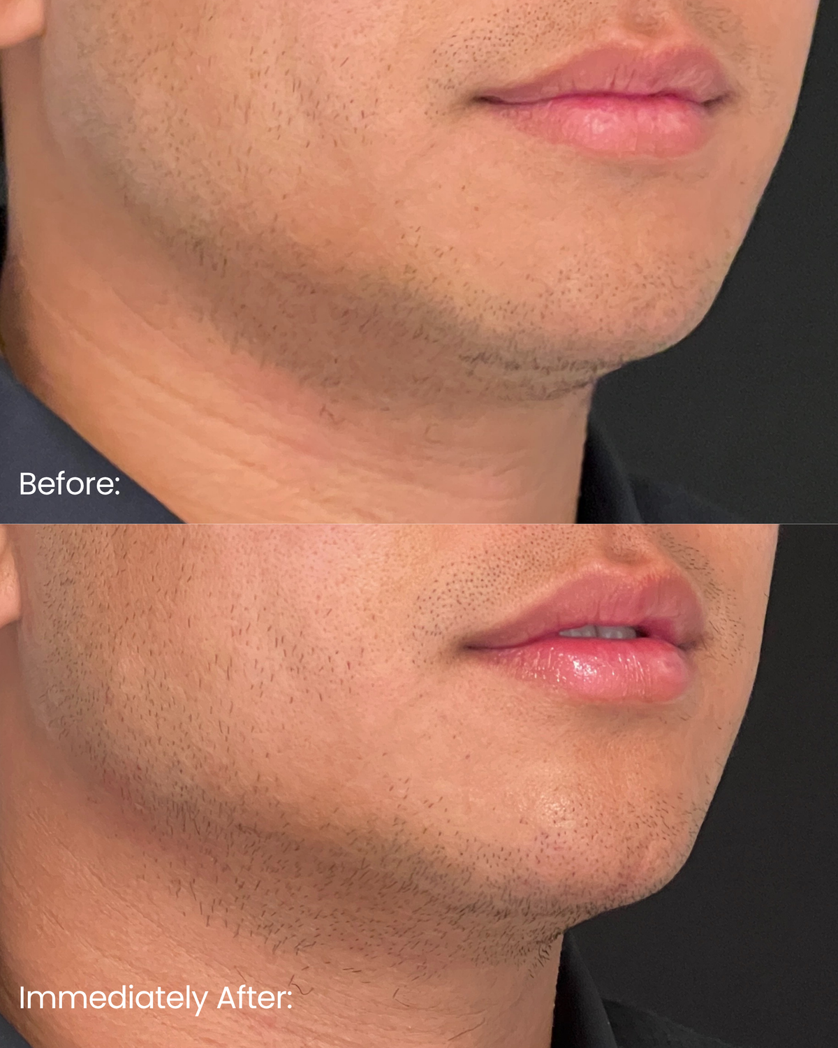 Chin Enhancement — Immediate Results