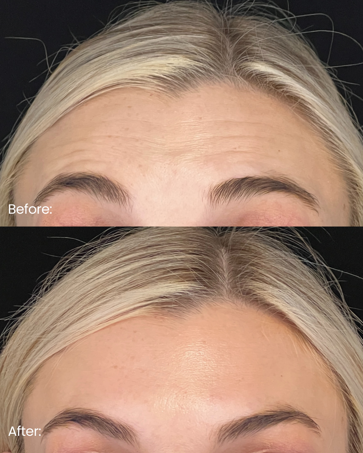 Letybo® — 2 Week Results