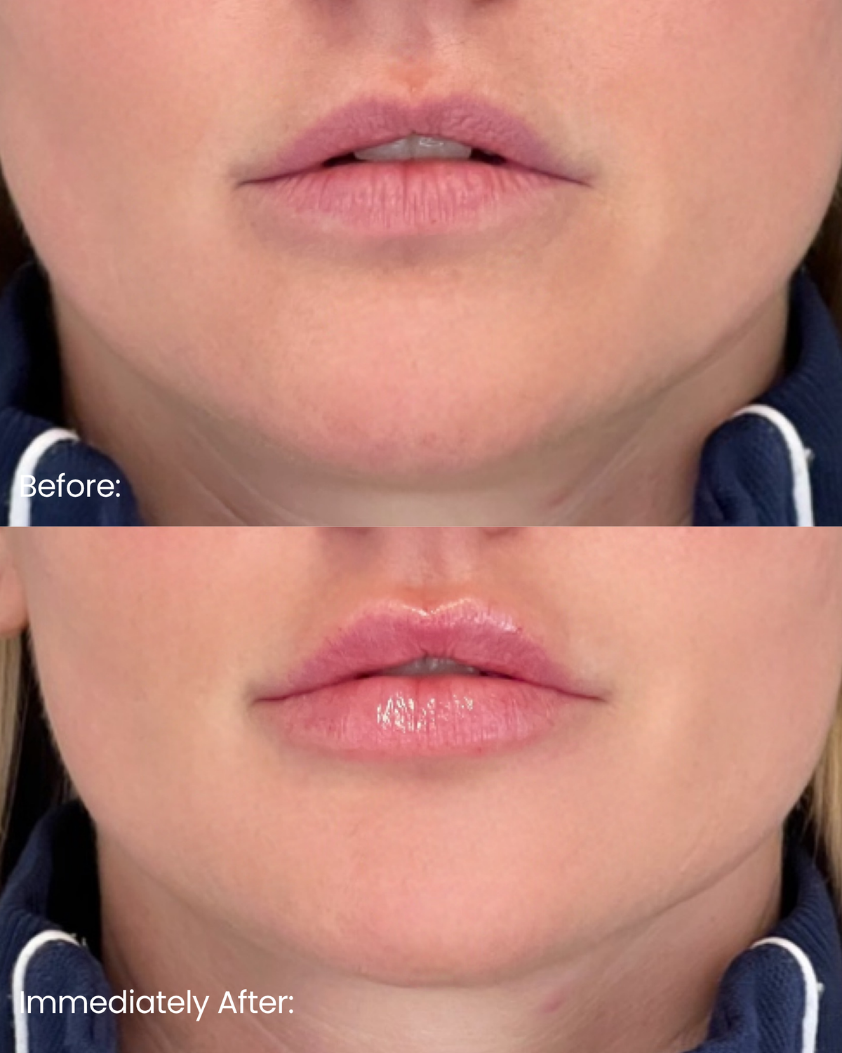 Lip Filler — Immediate Results